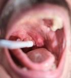 פצע מדמם בפה - תמונת המחשה